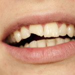 A woman with a chipped or broken tooth
