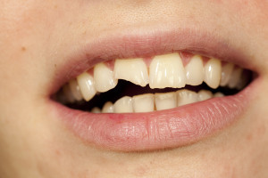 A woman with a chipped or broken tooth