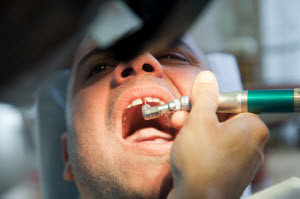 A dentist fixing a broken tooth
